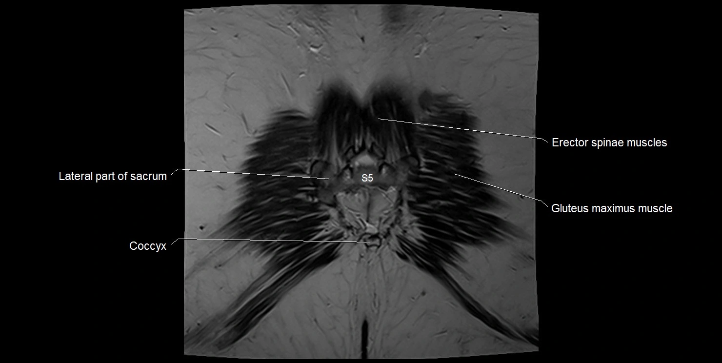 female pelvis coronal cross sectional anatomy image 36.webp
